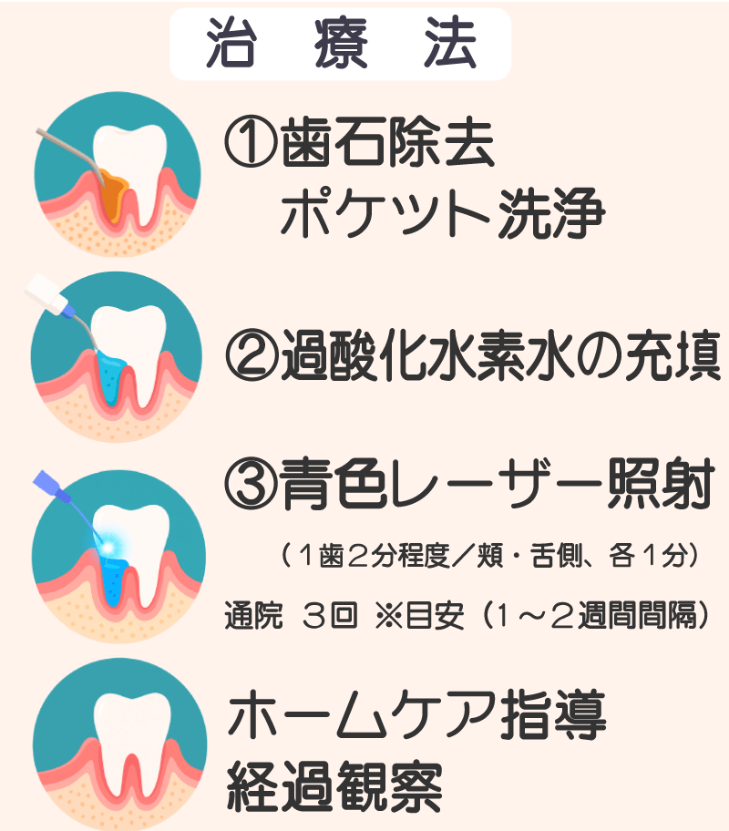 ブルーバイオラジカル治療の治療の流れ